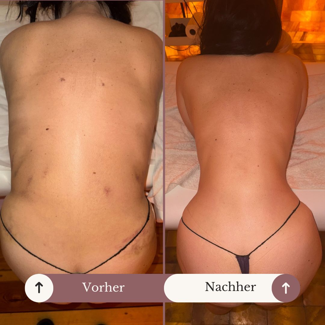 Post OP Lymphdrainage