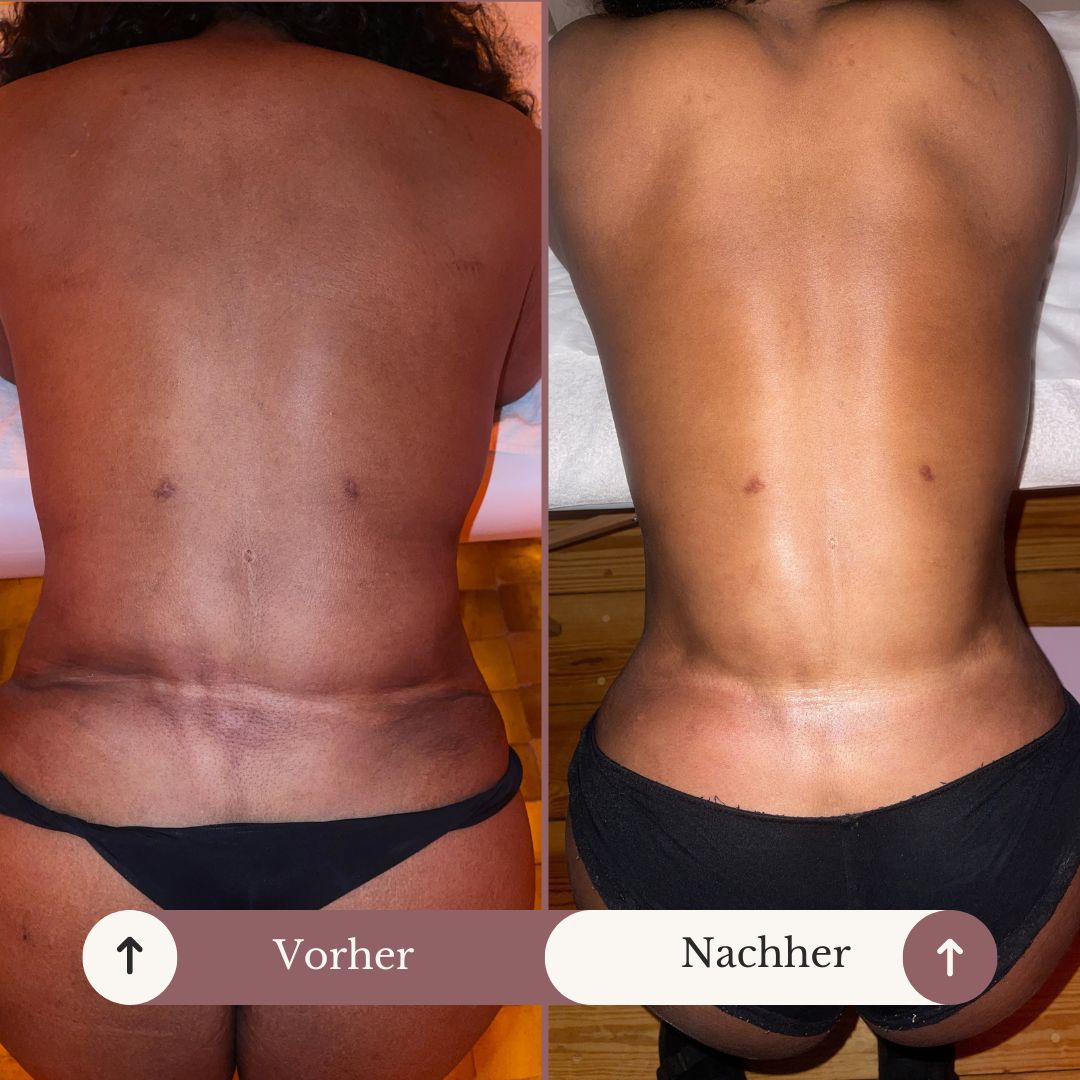 Post OP Lymphdrainage